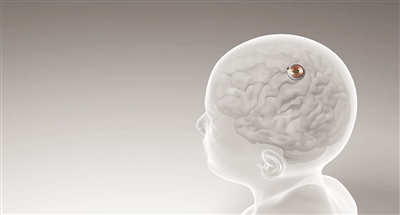 百事3娱乐：首例脑机接口设备人体移植完成